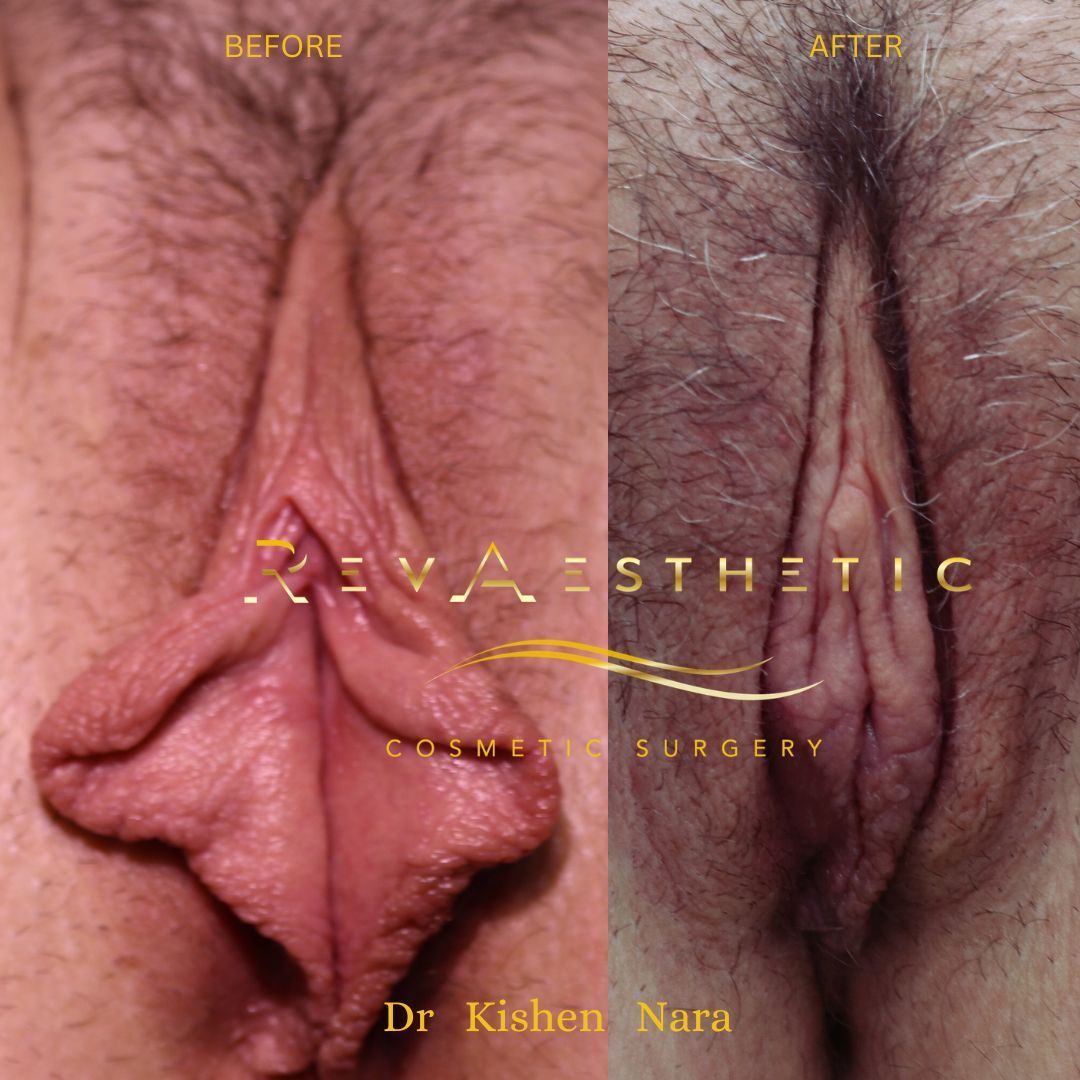 Labiaplasty before and after — Labia minoraplasty + clitoral hood reduction, before and after, Case 8, Dr Kishen Nara